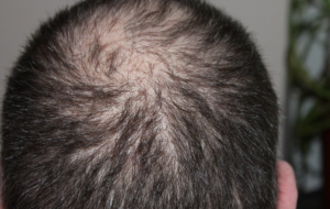 hair loss